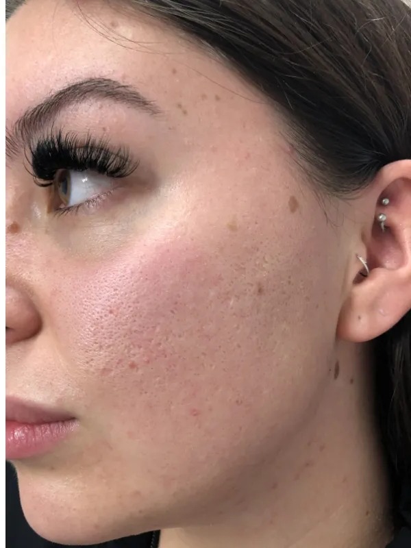 Acne scars & texture, after treatment