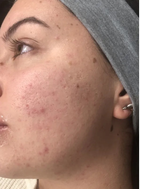 Acne scars & texture, before treatment